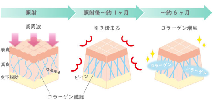 高周波（RF）治療イメージ画像
