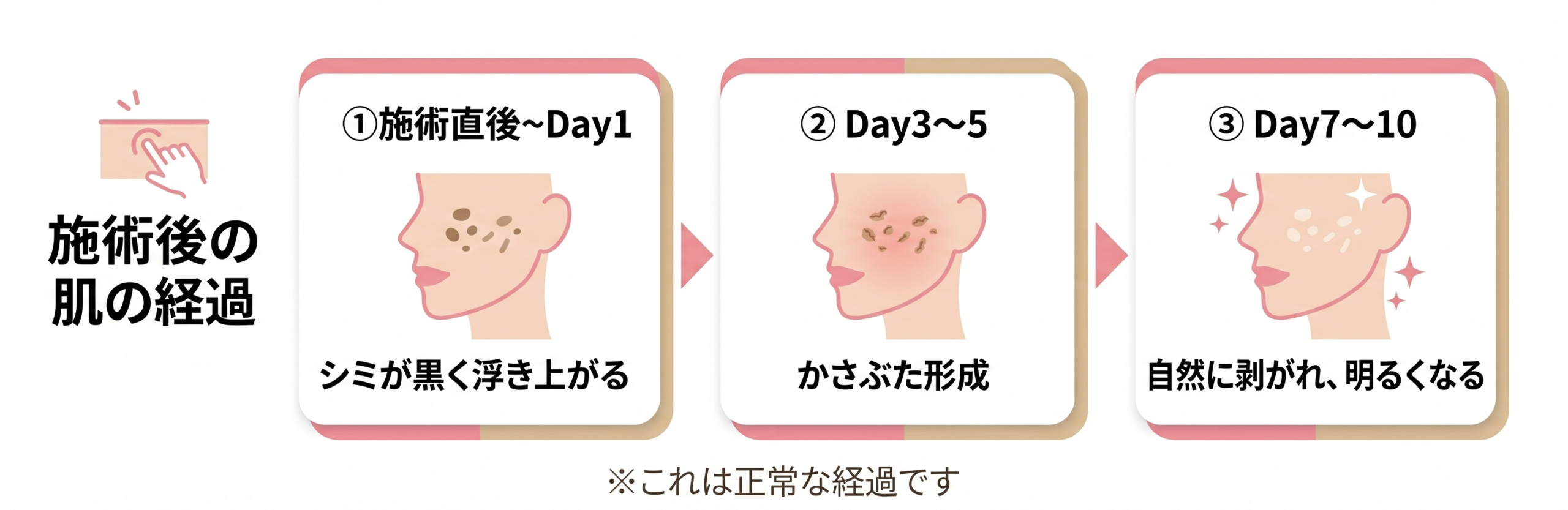ルメッカ施術後の肌の経過タイムライン（施術直後〜Day10）
