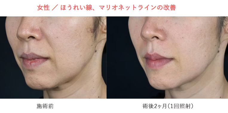 湘南美容クリニック XERF（ザーフ）ほうれい線・マリオネットラインの改善 施術前と術後2ヶ月